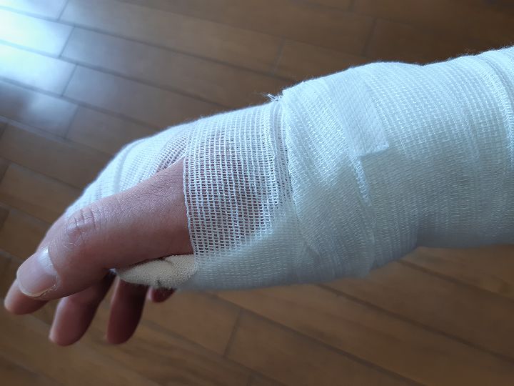 ギプス 保険適用